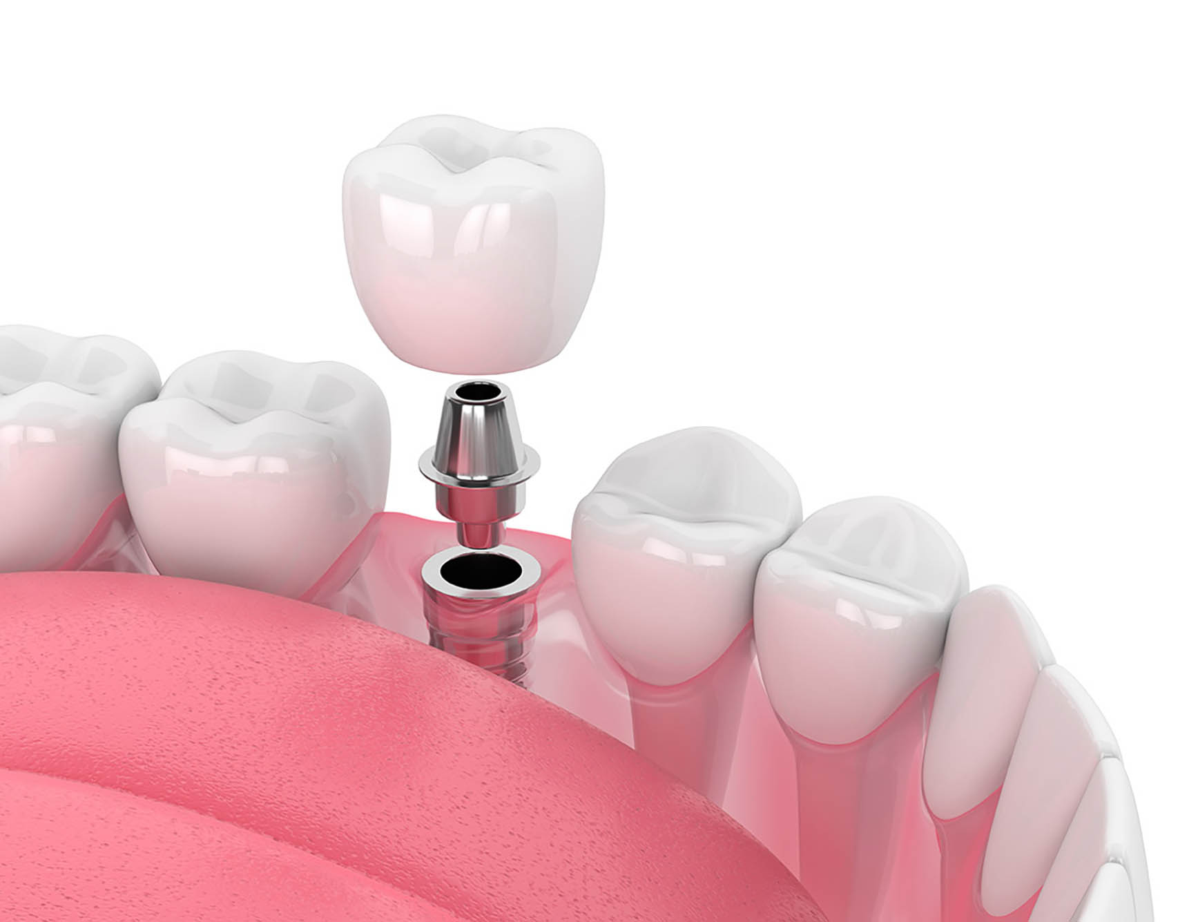 Referrals for Implants